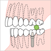 インプラント−天然歯