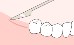 サージカルガイドを使用する治療の手順